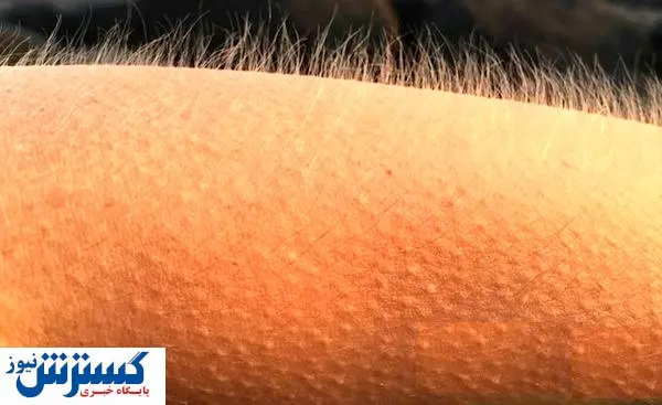 از علت تا درمان کبودی خارش دار