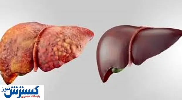 علائمی که خبر از ناراحتی کبد می دهند