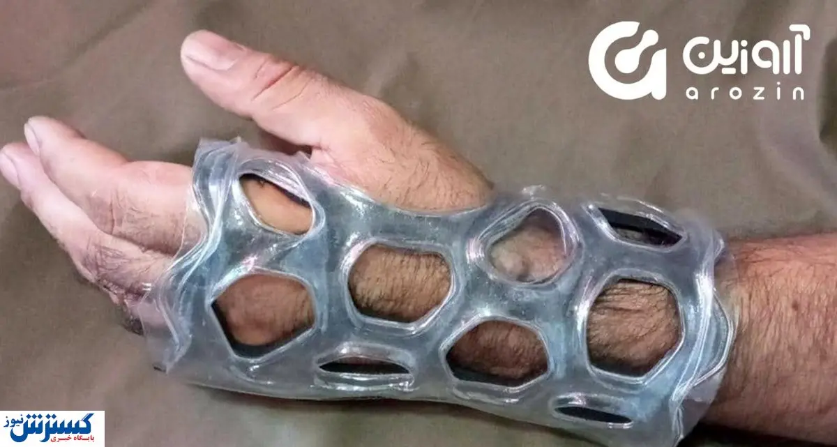 راهحل استارتاپ آروزین برای رفع مشکلات گچهای پلیاستر در شکستگی اندام