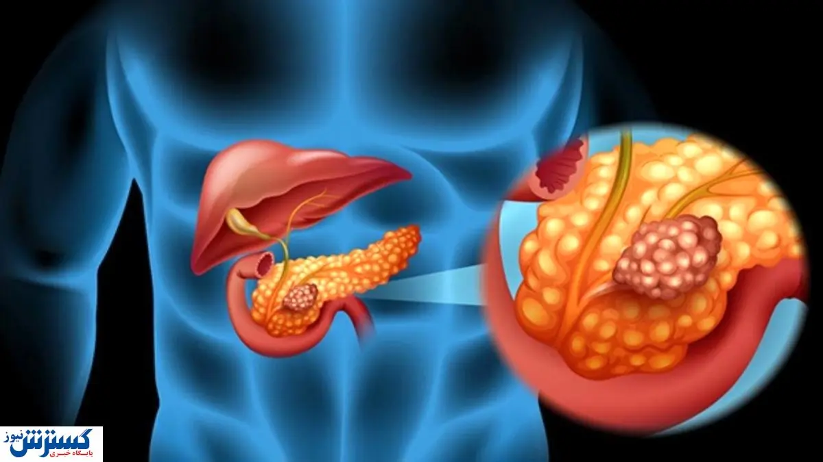 درمان نوین دیابت نوع ۱ و ۲ کشف شد