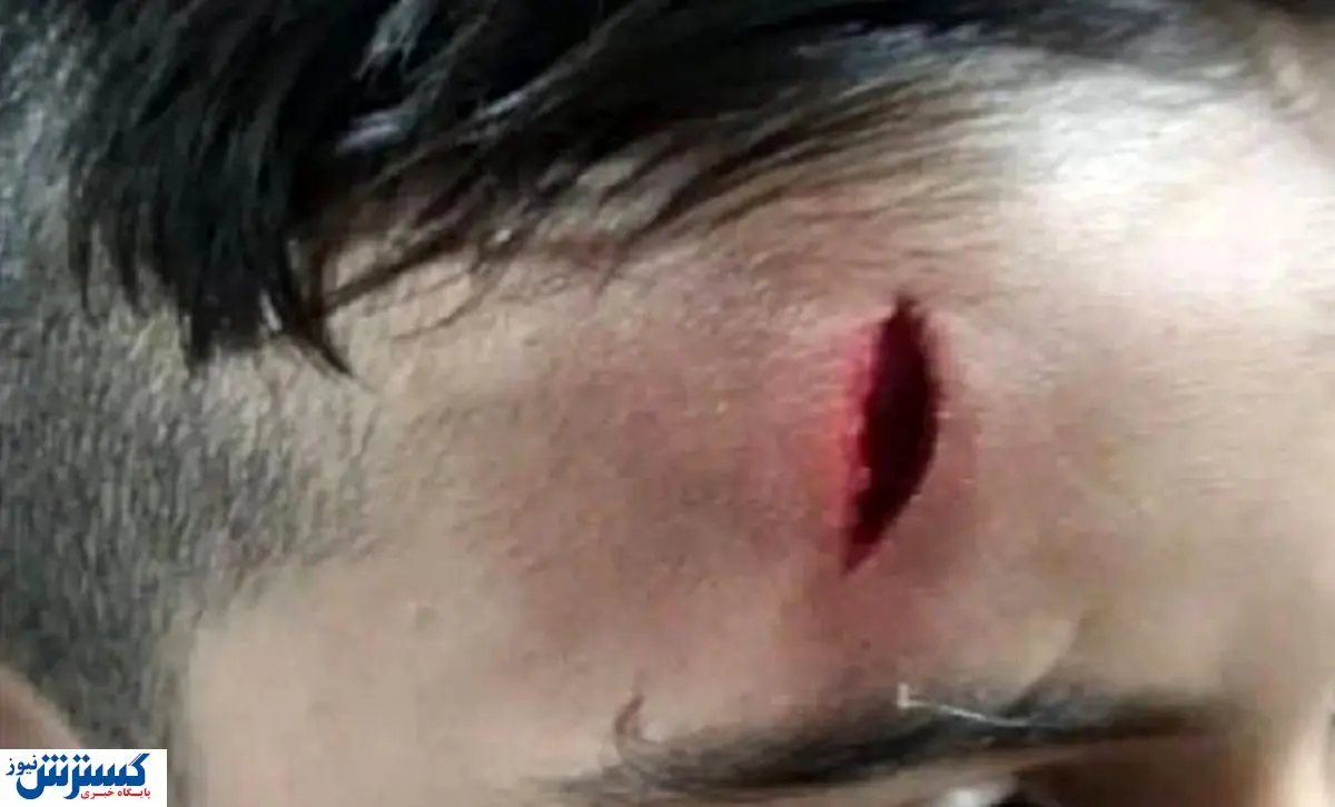 تنبیه وحشیانه یک دانش آموز توسط معلم در خرمآباد! + عکس (۱۳+)