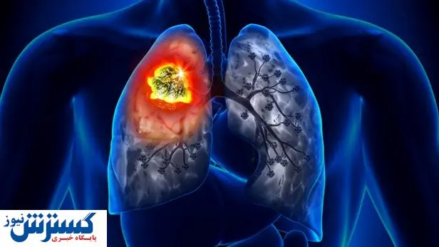 عامل ابتلا به سرطان مشخص شد/کاهش مقاومت بدنی به دنیال این واکنش بدن